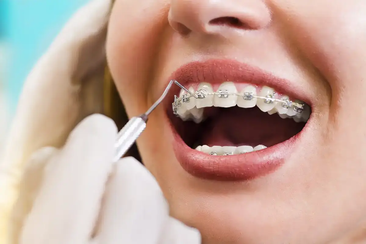 Braces
